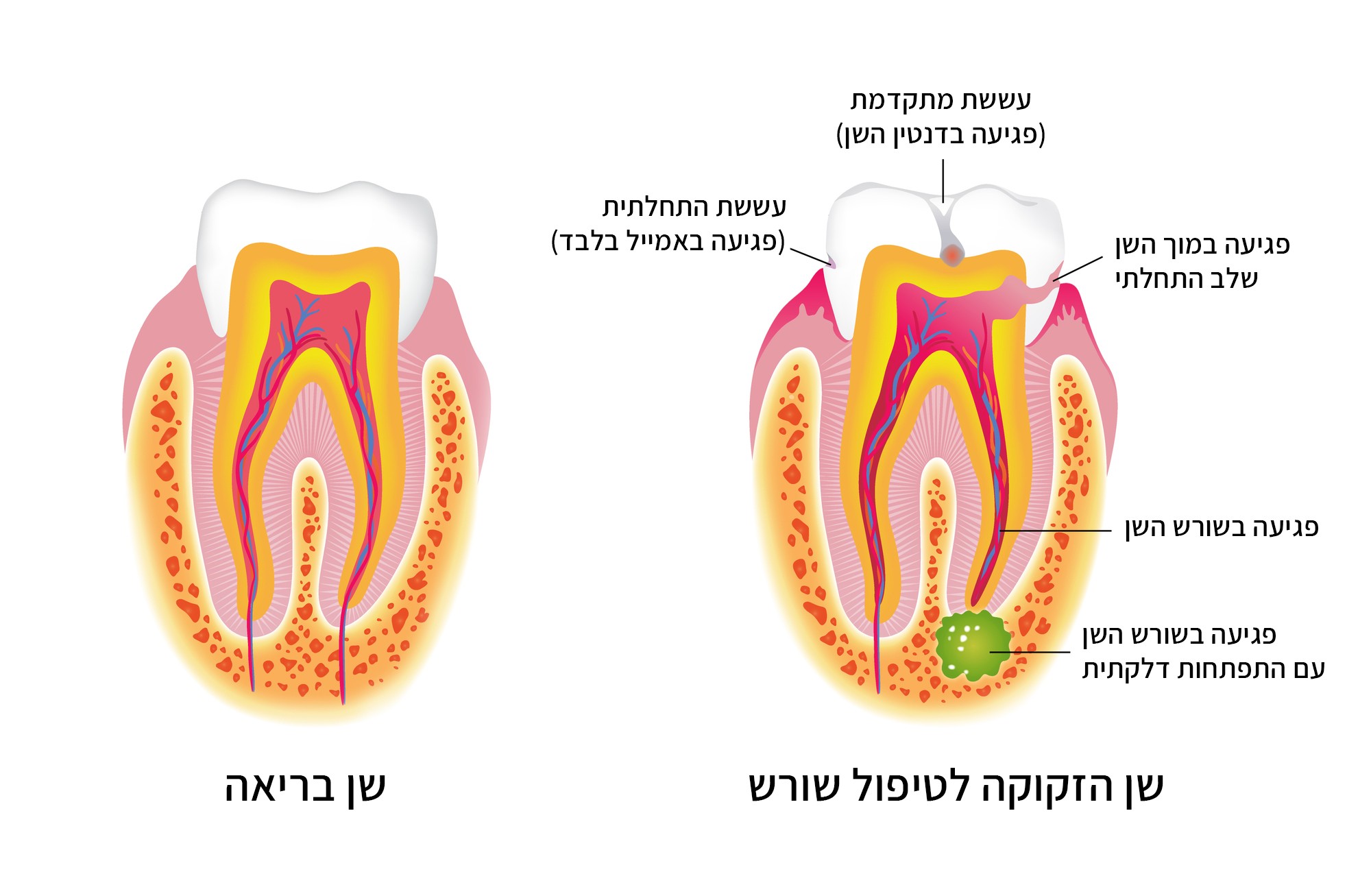 שן הזקוקה לטיפול שורש