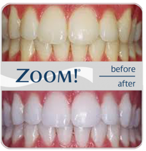 הלבנת שיניים בלייזר | תמונת לפני / אחרי